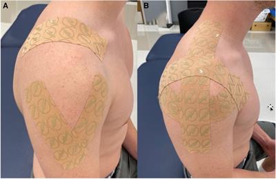 Evaluating the effects of two different kinesiology taping techniques on shoulder range of motion and proprioception in patients with hypermobile Ehlers–Danlos syndrome: a randomized controlled trial